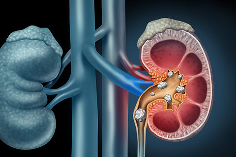 kidney stone treatment in pune