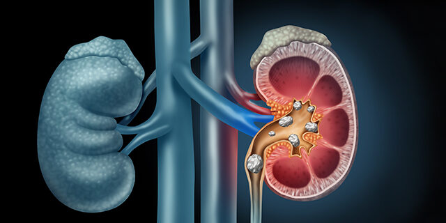 kidney stone treatment in pune