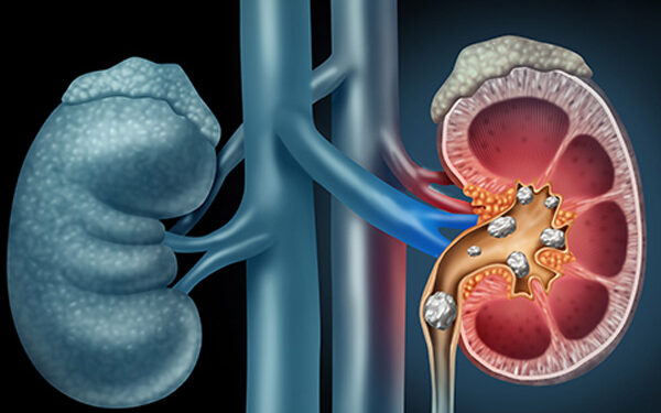 kidney stone treatment in pune
