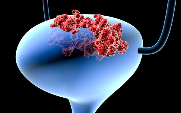 BLADDER CANCER
