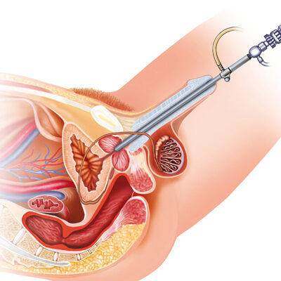 Laparoscopic Surgery