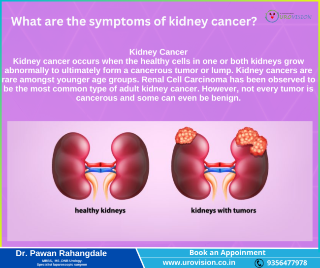 Expert Kidney Cancer Care by Dr. Pawan Rahangdale in Pune” Kidney Cancer Care by Dr. Pawan Rahangdale in Pune"