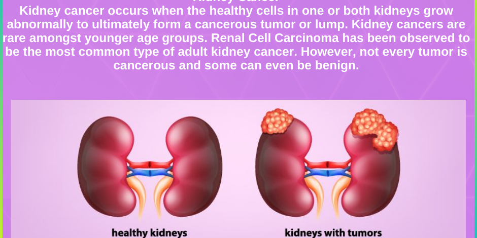 Expert Kidney Cancer Care by Dr. Pawan Rahangdale in Pune” Kidney Cancer Care by Dr. Pawan Rahangdale in Pune"