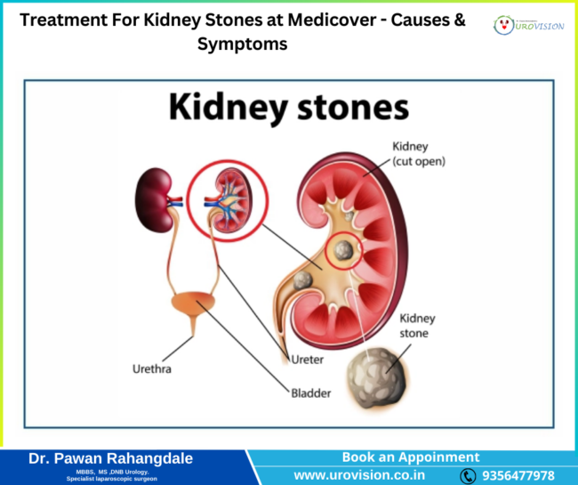 Treatment For Kidney Stones at Medicover – Causes & Symptoms Kindney Stones Treatment in Pune