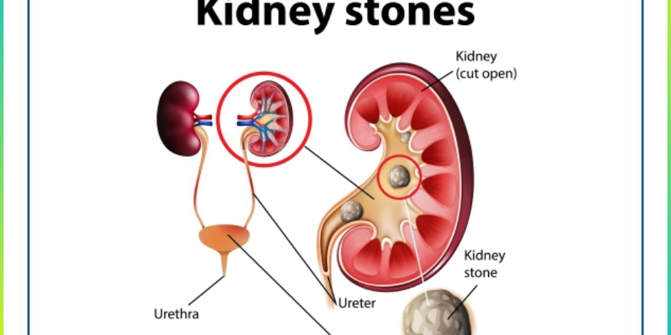 Treatment For Kidney Stones at Medicover – Causes & Symptoms Kindney Stones Treatment in Pune
