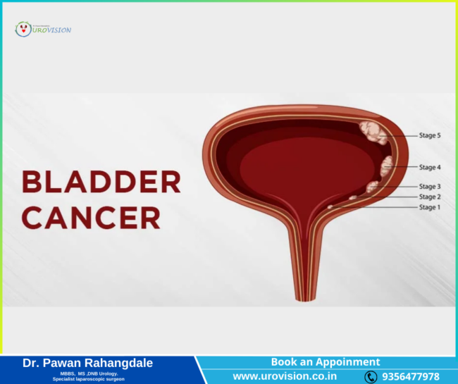 Understanding Bladder Cancer: Causes, Symptoms, and Treatment Options Bladder Cancer Treatment In Pune