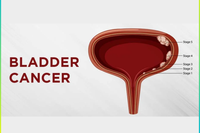 Bladder Cancer Treatment In Pune
