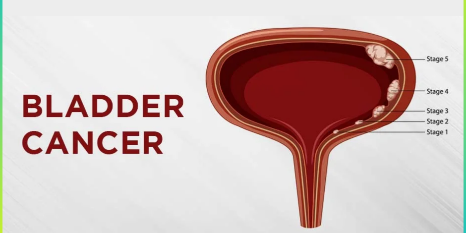 Understanding Bladder Cancer: Causes, Symptoms, and Treatment Options Bladder Cancer Treatment In Pune