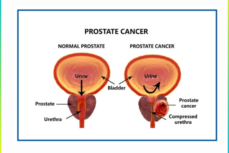 Prostate Cancer Treatment in pune