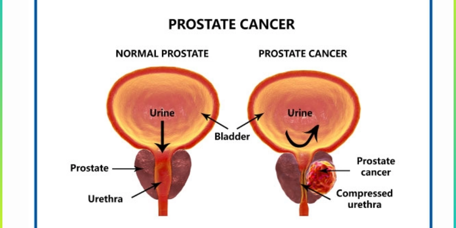Prostate Cancer Treatment in pune