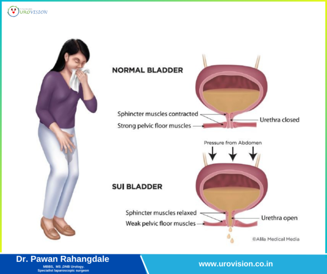 Urinary Incontinence: Understanding the Causes, Symptoms, and Treatment Options Urinary Incontinence