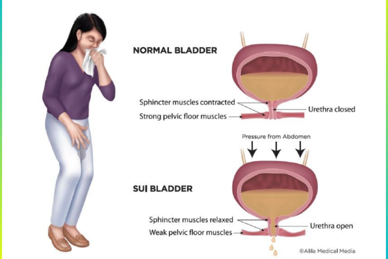 Urinary Incontinence