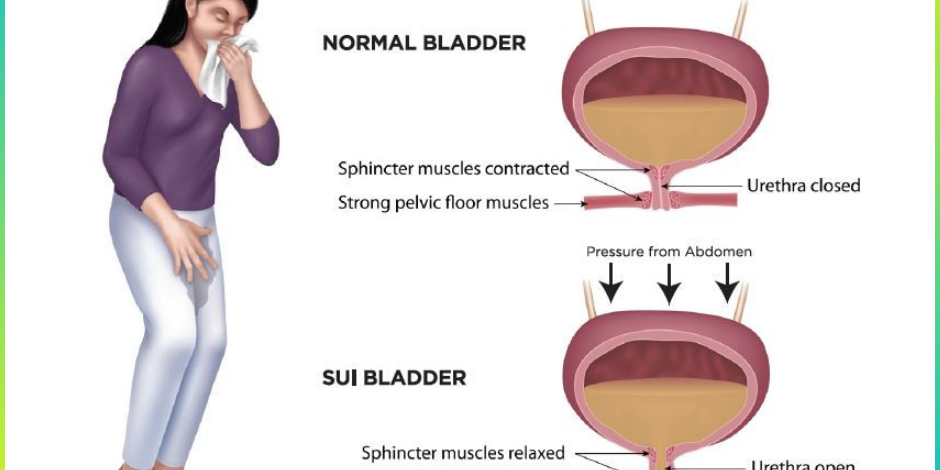 Urinary Incontinence: Understanding the Causes, Symptoms, and Treatment Options Urinary Incontinence