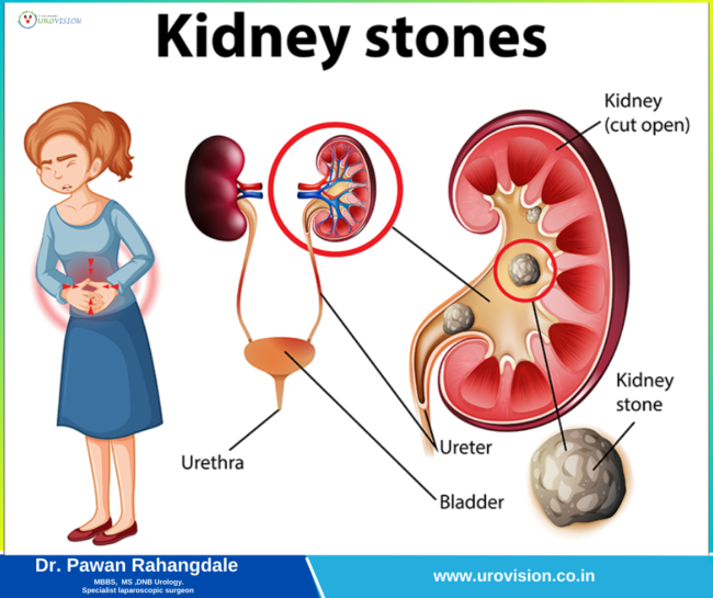 Kidney Stone Removal Surgery: Purpose, Procedure, Risks, and Recovery kidney stone Treatment in Pune