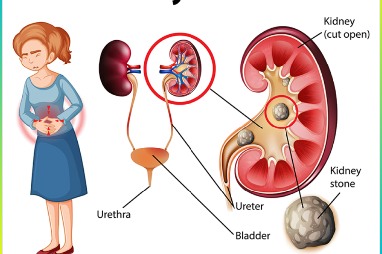kidney stone Treatment in Pune