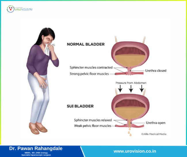 Understanding Stress Urinary Incontinence (SUI): Causes, Stress Urinary Incontinence