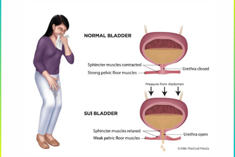 Stress Urinary Incontinence