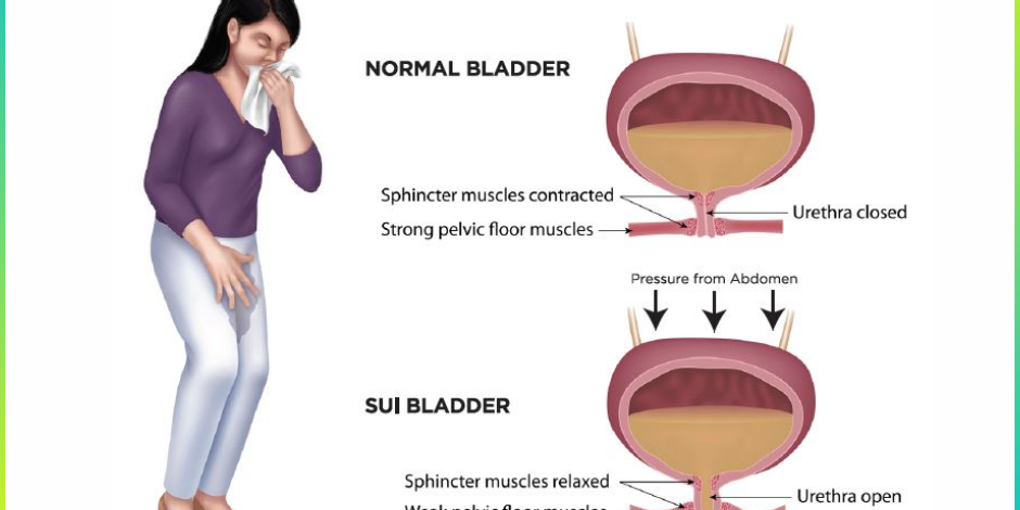 Understanding Stress Urinary Incontinence (SUI): Causes, Stress Urinary Incontinence