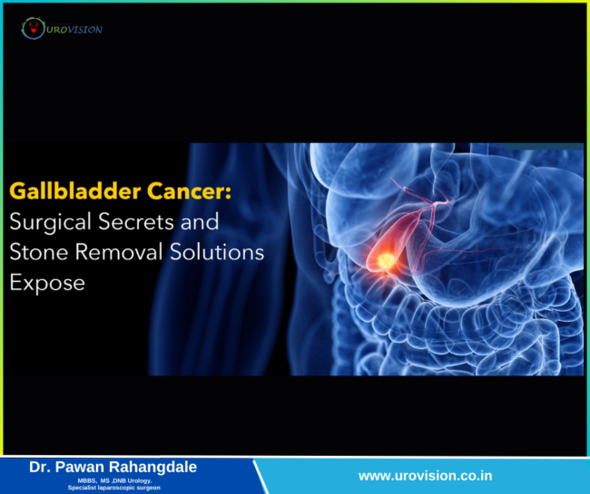 Gallbladder Cancer: Surgical Secrets and Stone Removal Solutions Exposed Gallbladder Tractment in Pune