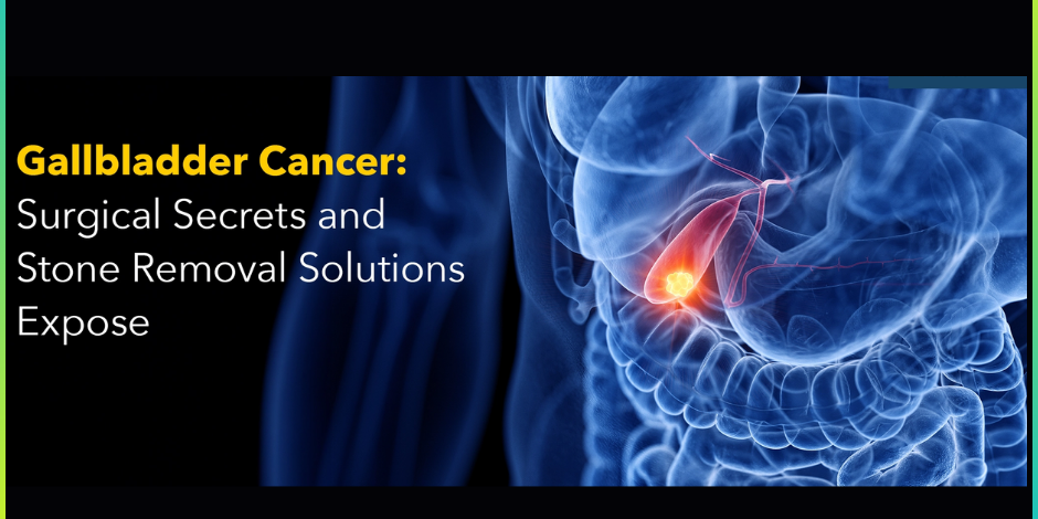 Gallbladder Cancer: Surgical Secrets and Stone Removal Solutions Exposed Gallbladder Tractment in Pune