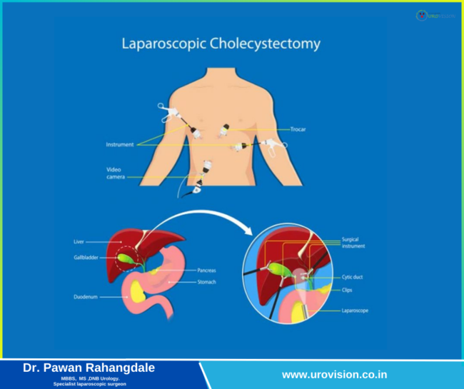 Laparoscopic Gastroplasty