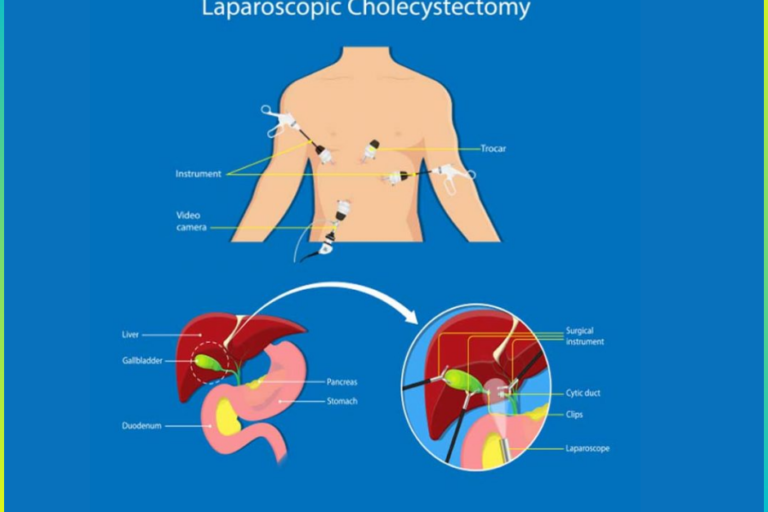 Laparoscopic Gastroplasty