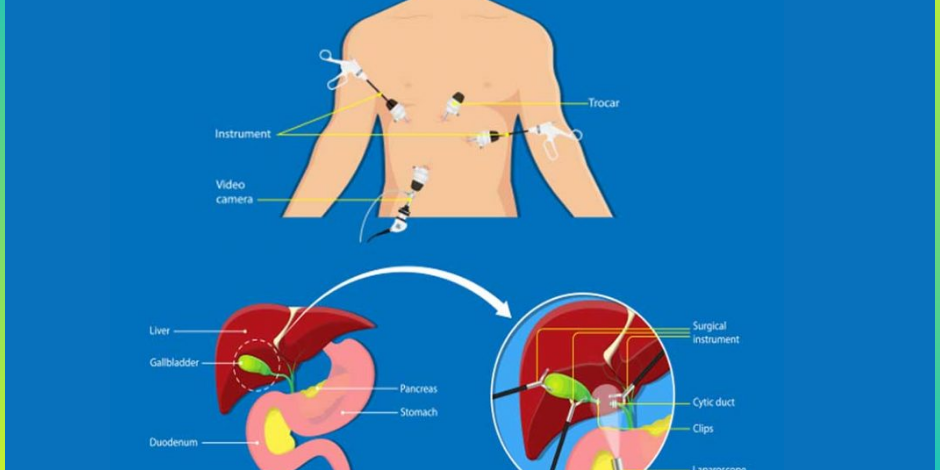 Laparoscopic Gastroplasty
