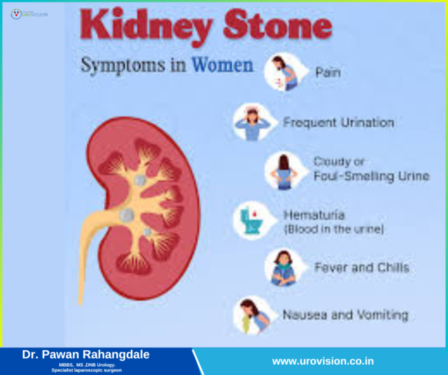 Kidney Stones: Symptoms in Men and Women Kidney Stones Treatment in Pune