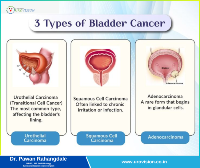 bladder cancer specialist in Pune
