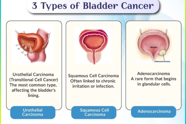 bladder cancer specialist in Pune