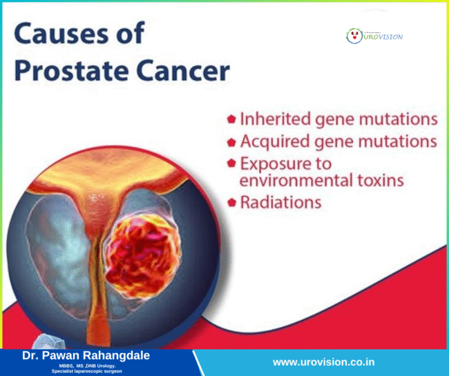 Prostate Cancer Treatment in Pune