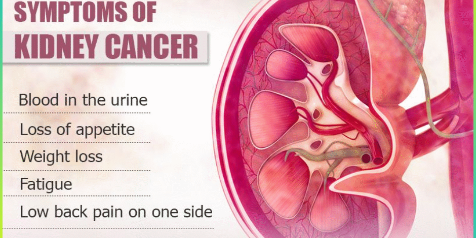 Kidney Cancer Treatement in Pune